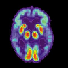 Dr. David Perlmutter Interviewed By Medscape – Carbs and Dementia